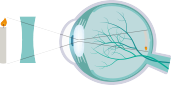 nearsightedness lasik san diego