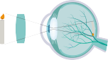 farsightedness lasik san diego